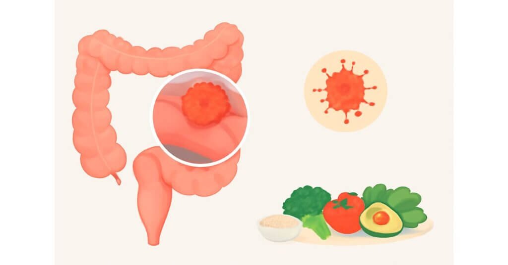 Minh họa về ung thư đại trực tràng, với polyp ung thư được phóng to trong đại tràng và các thực phẩm lành mạnh giúp phòng ngừa bệnh.